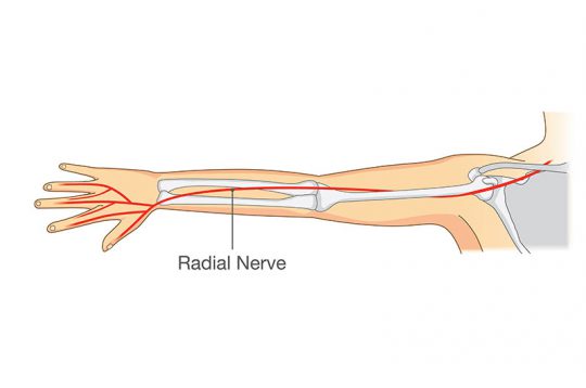 RADIAL NERVE ENTRAPMENT – Op. Dr. Çağatay KEMERLİ