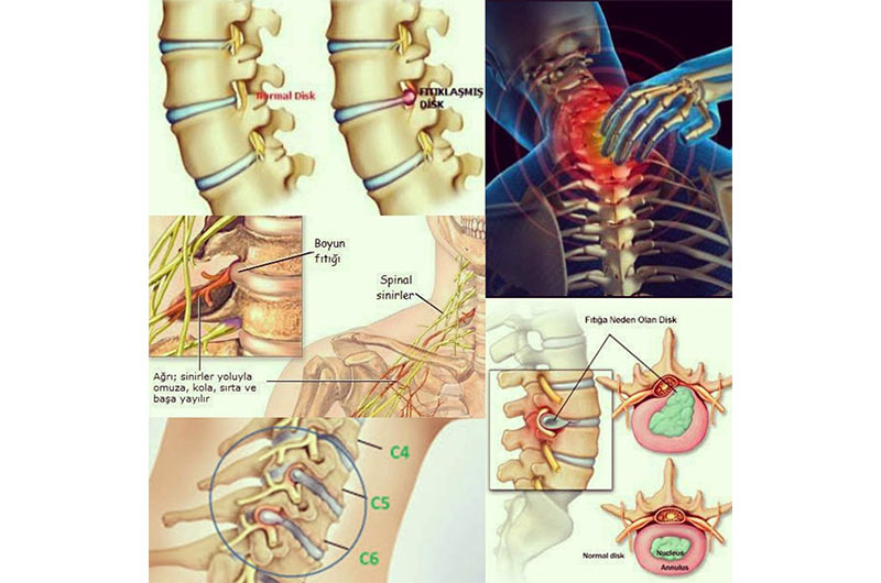boyun-fitig-tedavi.jpg