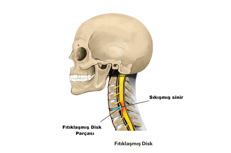 boyun-fitigi-tedavi.jpg
